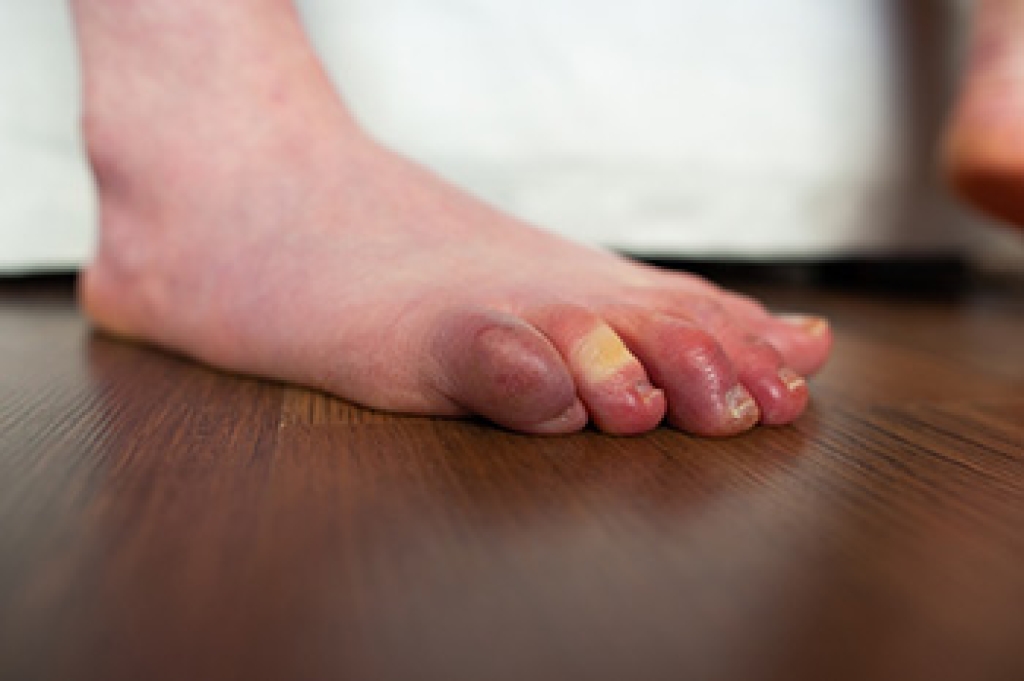 Trench Foot Explained